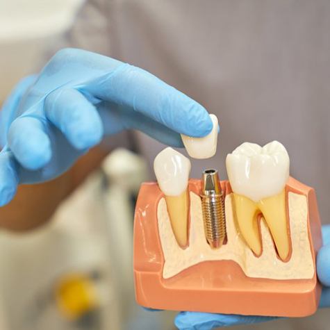Dentist placing a crown onto a dental implant model