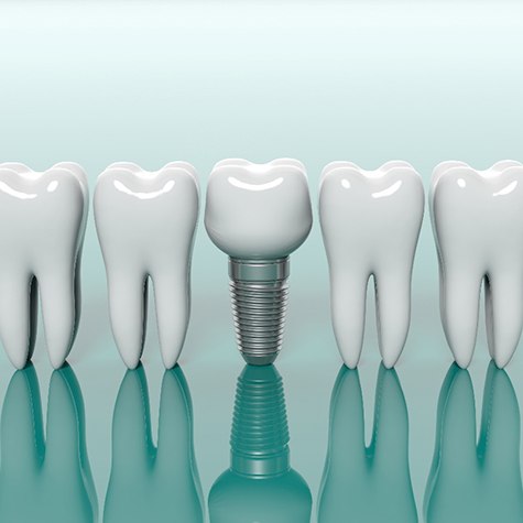 Model dental implant next to model teeth for comparison 
