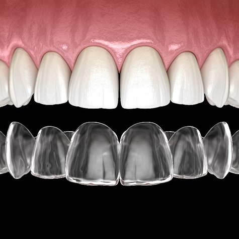 Digital image of a top row of teeth and a customized Invisalign aligner
