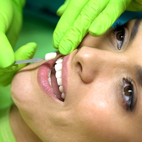 A woman having a porcelain veneer placed over a tooth located on the top row of teeth