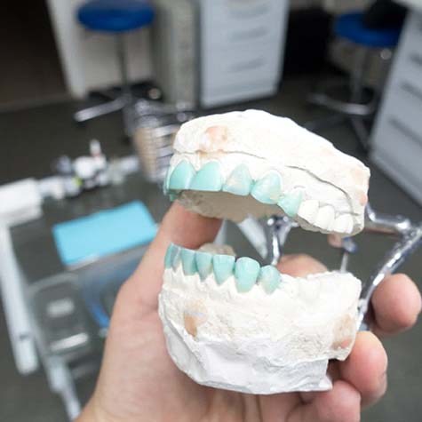 A plaster mold of a mouth that includes artificial teeth