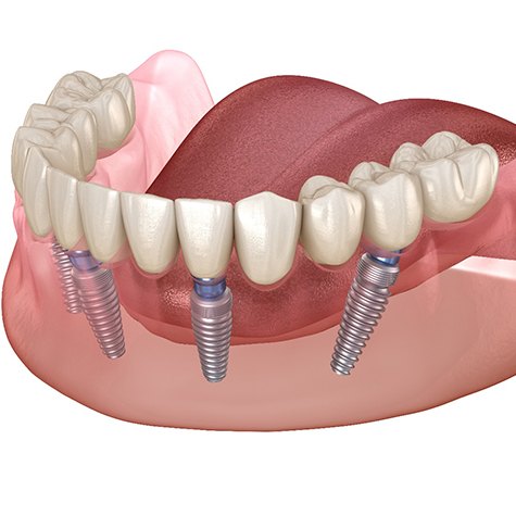 Diagram of All-On-4 dental implants in Doylestown