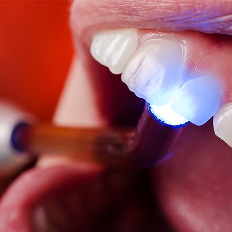 Smile receiving dental bonding