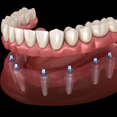 a digital illustration of implant dentures