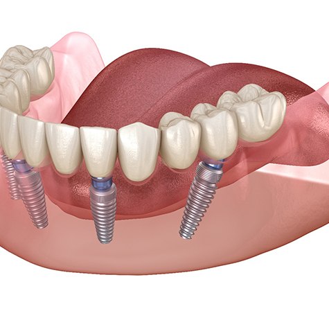 diagram of implant dentures in Doylestown 