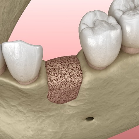 Before and after diagram of bone grafting in Doylestown