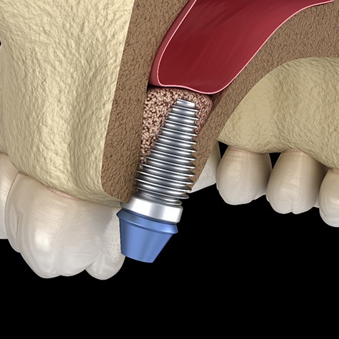 Diagram of sinus lift in Doylestown for dental implant placement