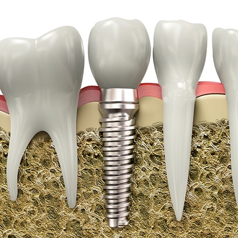 Diagram of dental implant in Doylestown after PRP Therapy in Doylestown