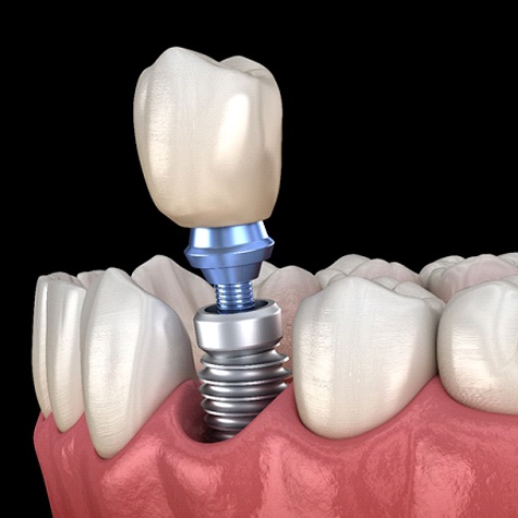 Dental implant in Doylestown