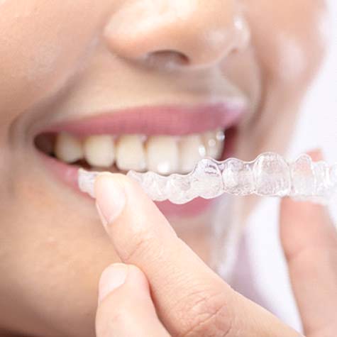 The cost of Invisalign in Doylestown