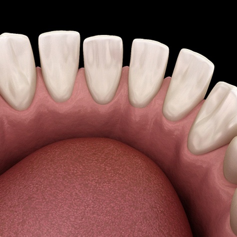 Digital image of gapped teeth located on the bottom arch of teeth