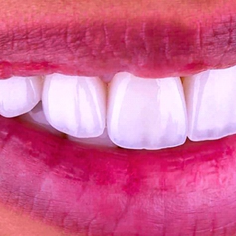 An image of a person’s smile, complete with the top row of teeth showing after receiving porcelain veneers