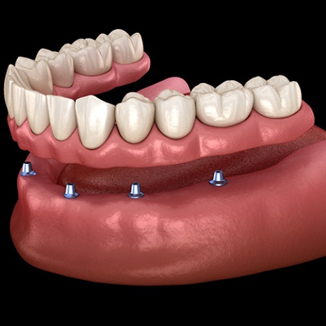 Digital image of an implant-retained denture preparing for placement on top of the surgically placed implants