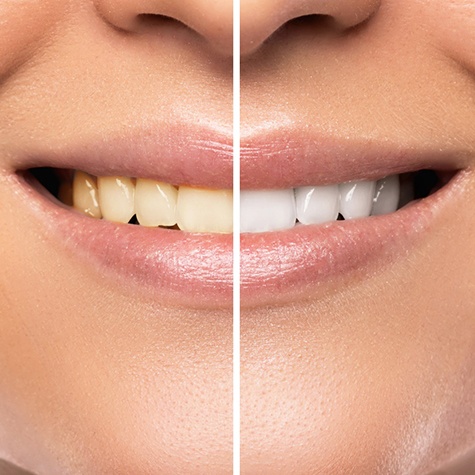 Before and after teeth whitening in Doylestown