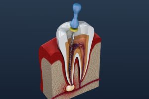 Illustration of tool cleaning tooth’s interior during root canal treatment