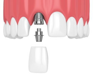 an image of a dental implant replacing a missing front tooth